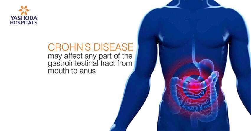 GERD (gastroesophageal reflux disease) may lead to Barrett’s esophagus