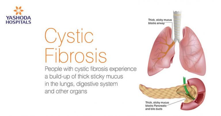 Cystic Fibrosis: Causes, Symptoms, Risks, Tests, Diagnosis and Treatment