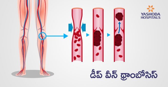 డీప్‌ వీన్‌ థ్రాంబోసిస్‌(Deep Vein Thrombosis)