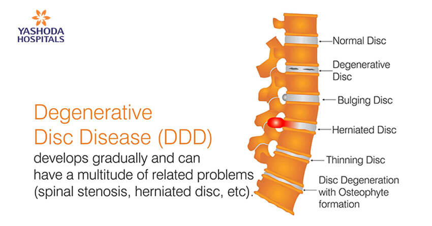 3 Common Symptoms of a Bulging Disc Infographic