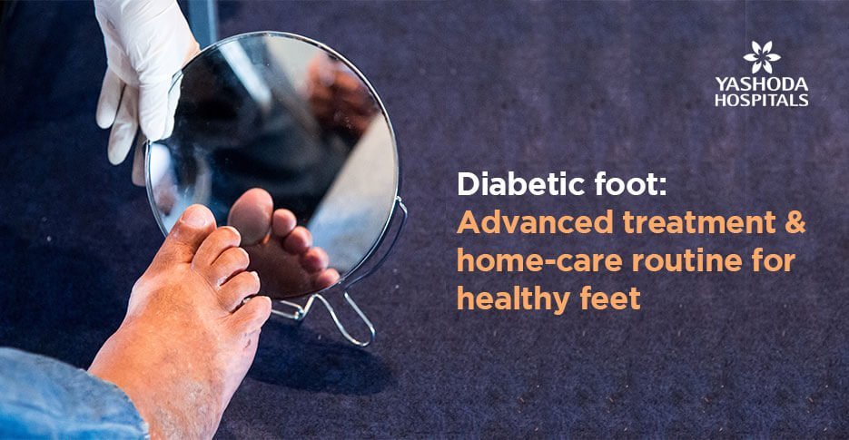 How to take care of diabetic foot at home? How to treat it using advanced methods?