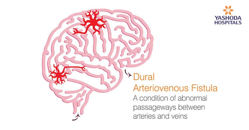 Dural Arteriovenous Fistula