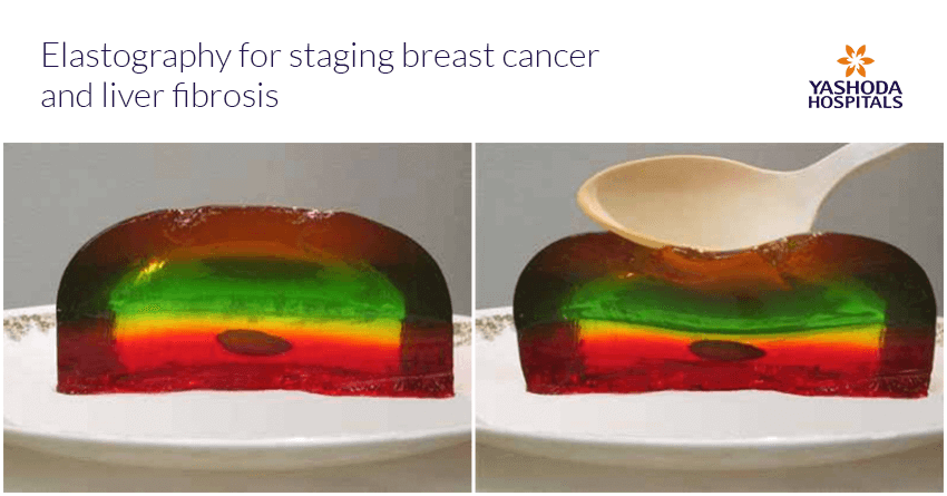 Elastography – A promising tool for staging of breast cancer and liver diseases