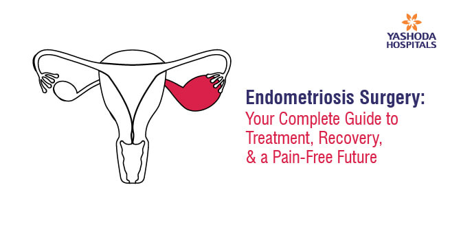 Endometriosis Surgery: Your Complete Guide to Treatment, Recovery, and a Pain-Free Future