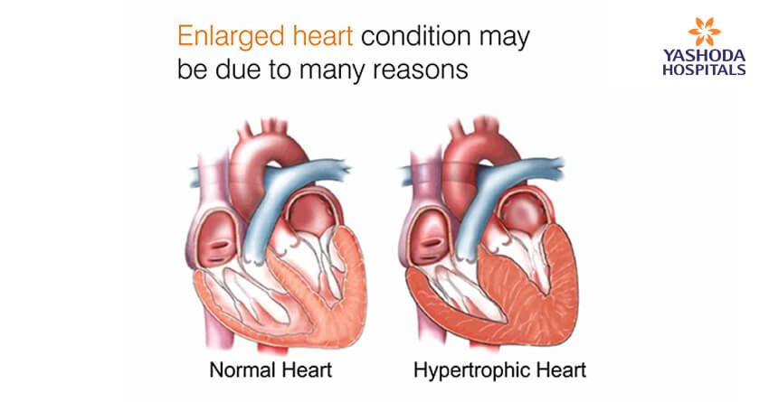 Enlarged Heart What are its causes?