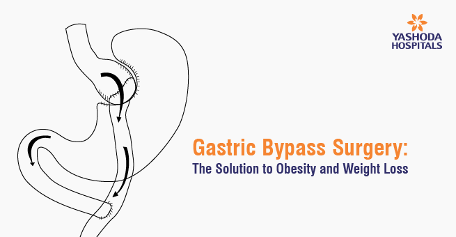 Gastric Bypass Surgery: The Solution to Obesity and Weight Loss