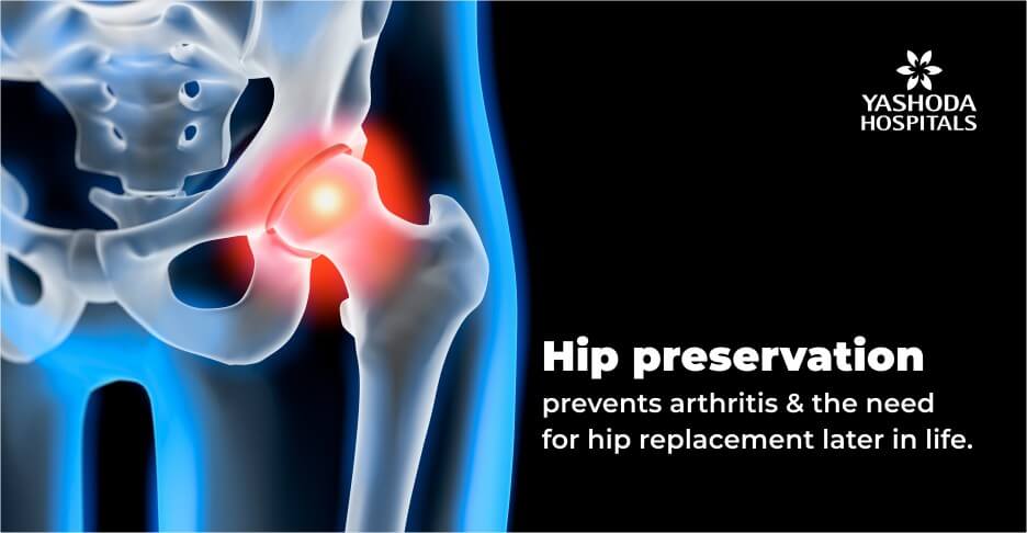 Techniques of hip joint preservation - Yashoda Hospital