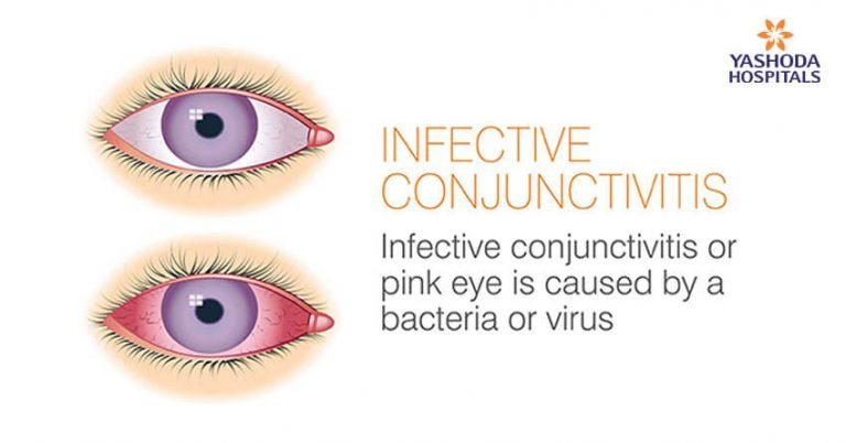 Infective Conjunctivitis