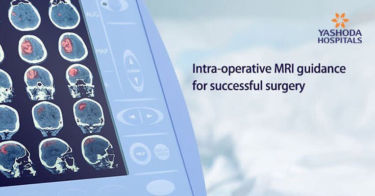 Brain surgery using intraoperative MRI: How does Intraoperative MRI help in neurosurgery?