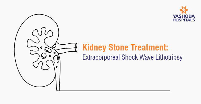 Kidney Stone Treatment_Main