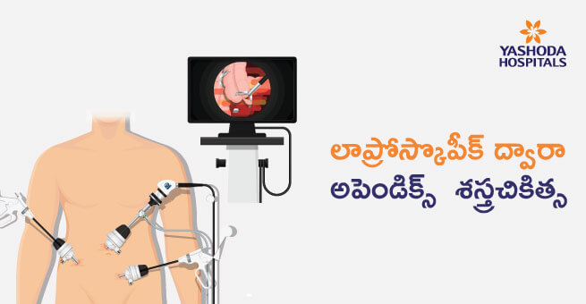 Laparoscopic Appendix Removal Surgery