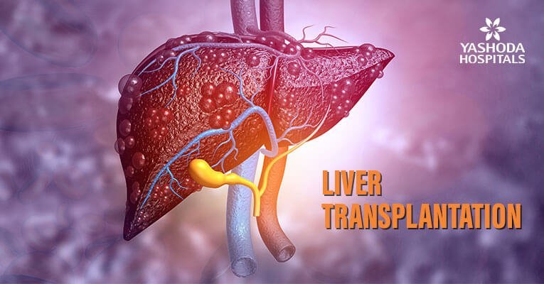 Liver Transplantation Current Status And Challenges - 