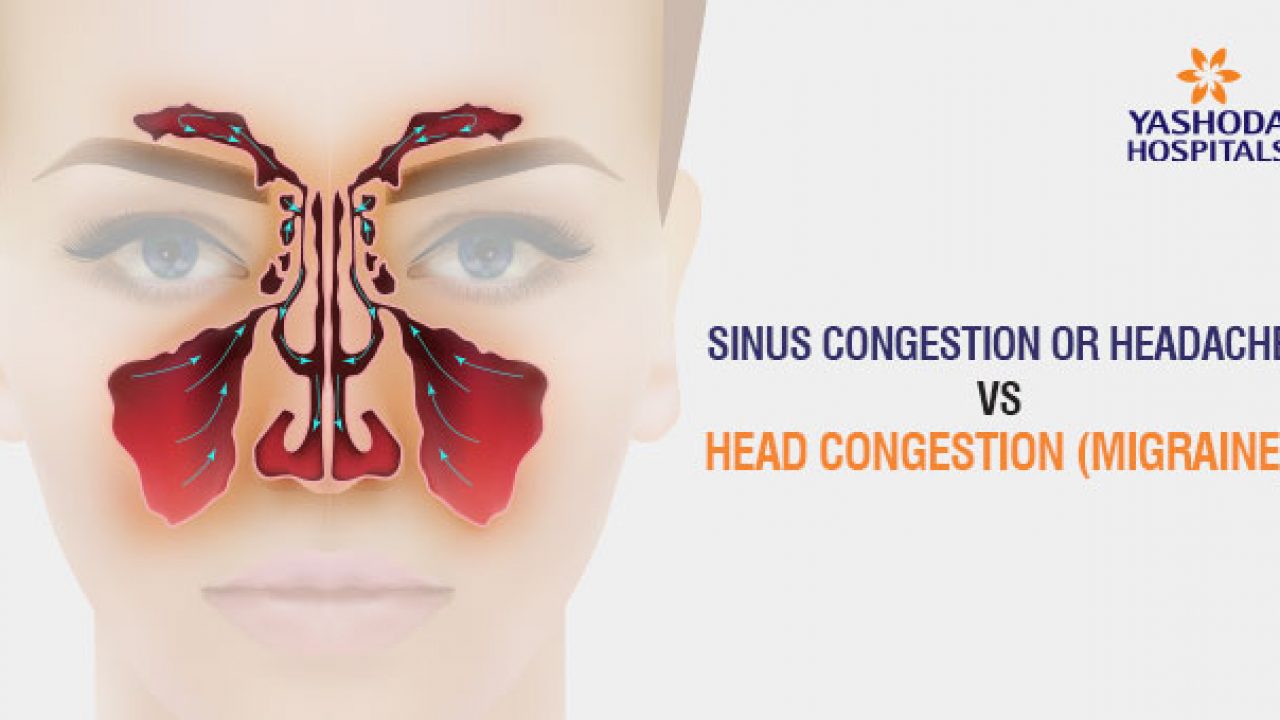 Sinus headache without deals congestion