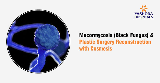 Mucormycosis (Black Fungus) and Plastic Surgery Reconstruction with Cosmesis