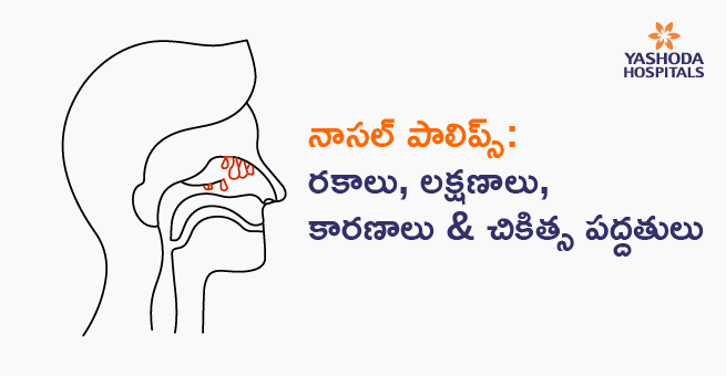 నాసల్ పాలిప్స్: రకాలు,  లక్షణాలు, కారణాలు & చికిత్స పద్దతులు