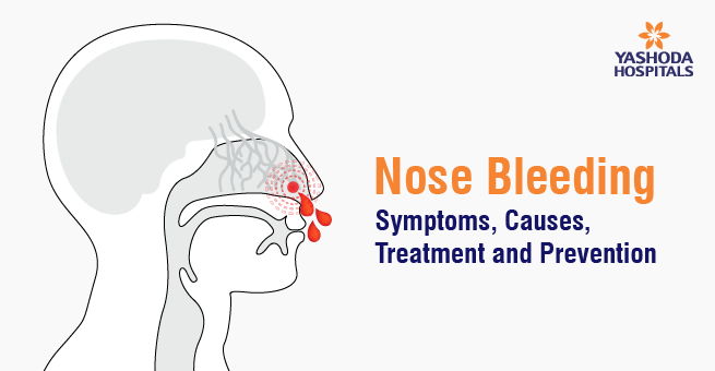 Nose Bleeding: Symptoms, Causes, Treatment and Prevention