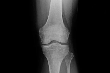 Osteonecrosis Of The Knee: What Is Osteonecrosis Of The Knee, Its Causes?