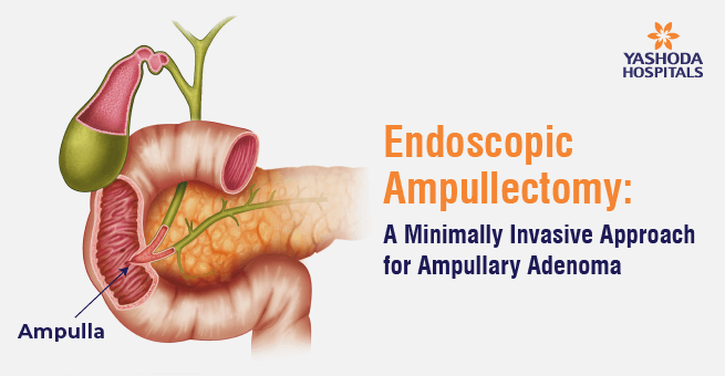 Endoscopic Ultrasound Guided Hepatico - Gastrostomy - Yashoda Hospitals