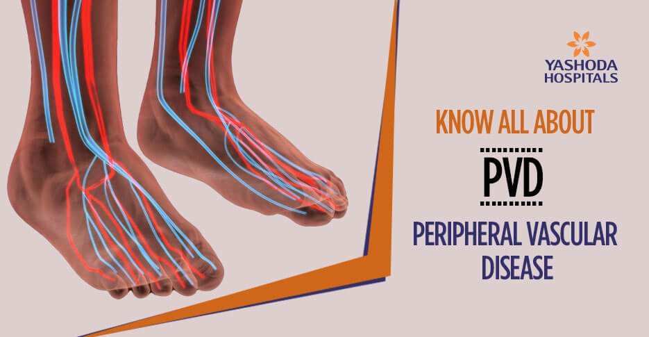 How to treat and prevent Peripheral vascular disease?