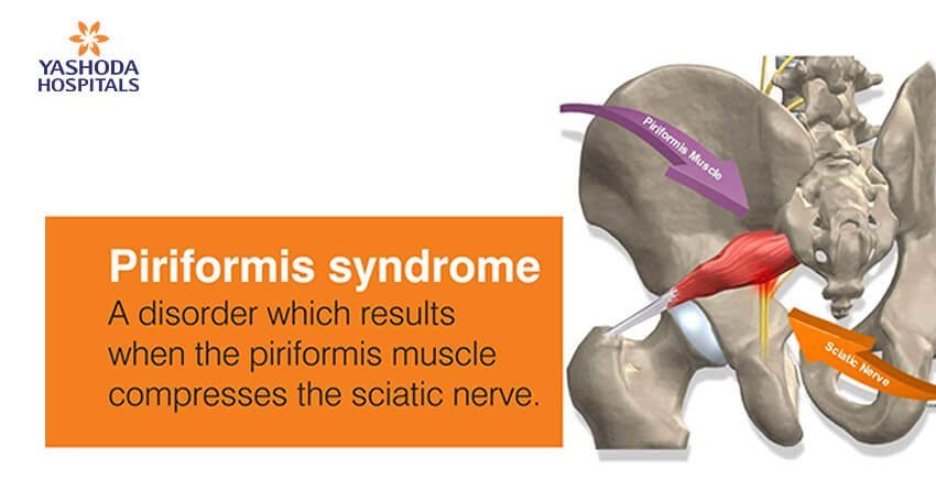 How to diagnose and treat Piriformis Syndrome?