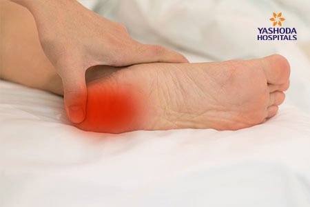 Plantar Fasciitis And Bone Spurs: Symptoms And Complications