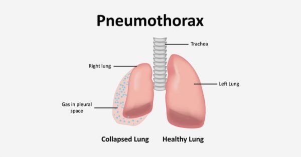 What is Lung Disease | Lung Diseases Types | Definition and Causes