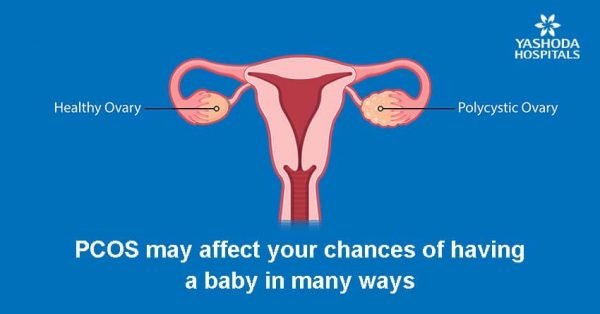 Does polycystic ovarian syndrome cause cancer