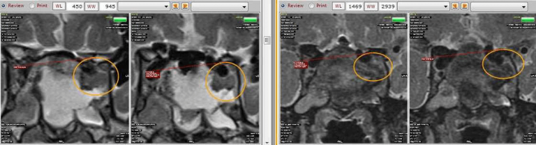 Endoscopic Transsphenoidal Pituitary Surgery With IMRI