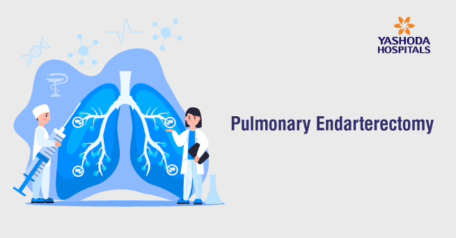 Pulmonary Endarterectomy: A Complex lifesaving lung surgery