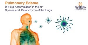 pulmonary edema