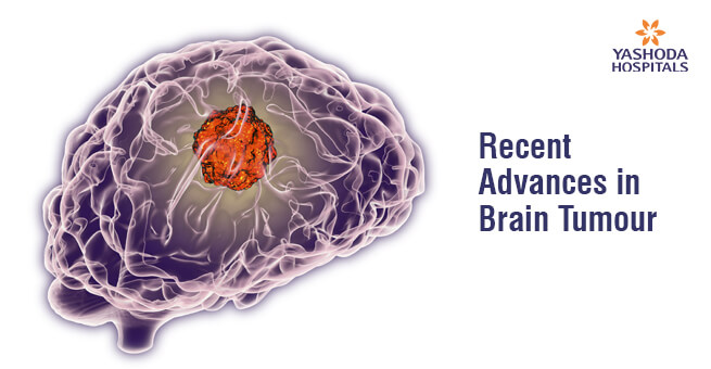 Recent Advances in Brain Tumour