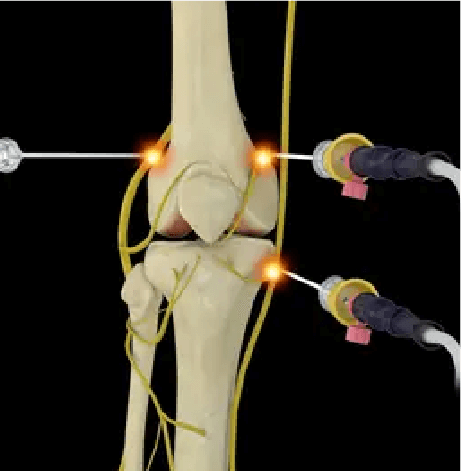 What conditions require knee replacement