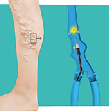 Total knee replacement Surgery Cost in Hyderabad, India