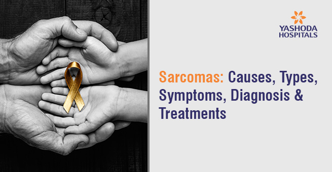 Sarcomas: Causes, Types, Symptoms, Diagnosis & Treatment