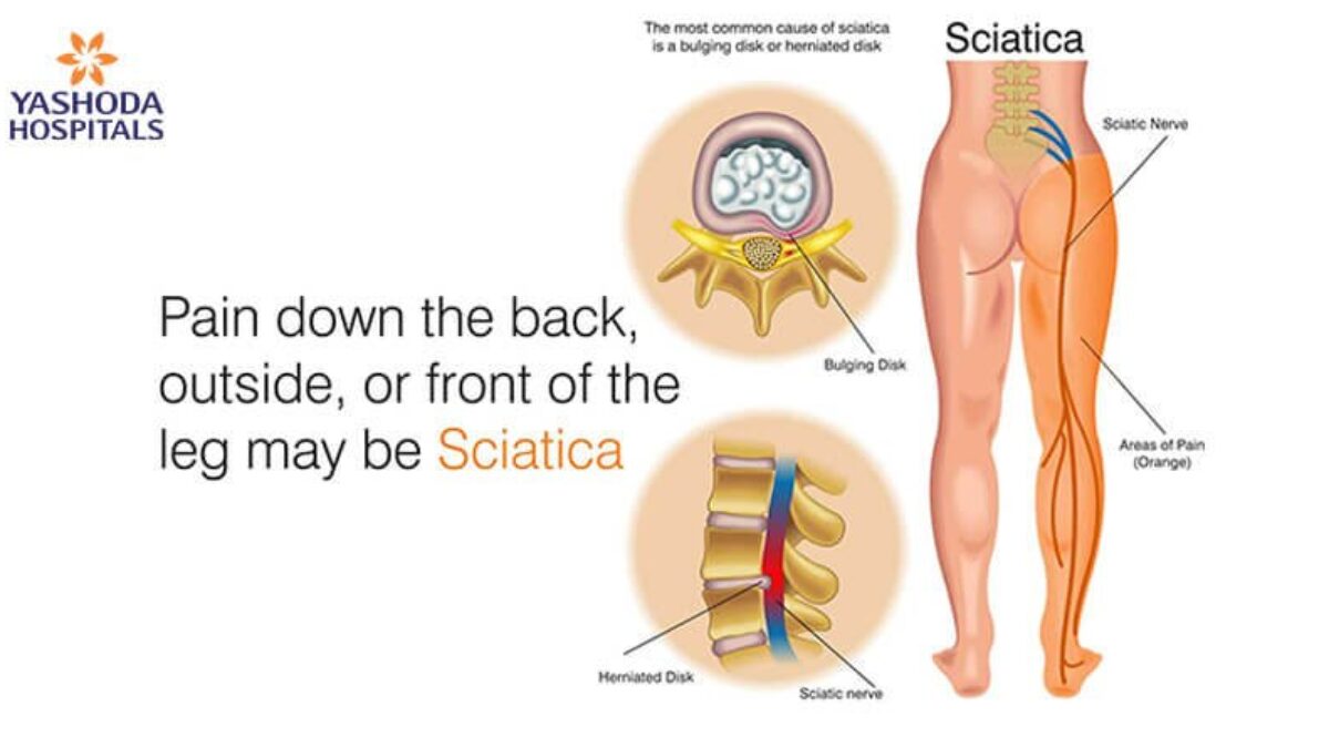 How to diagnose and treat Sciatica