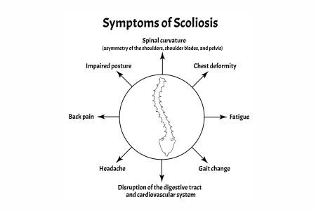 Scoliosis: What Are The Symptoms, Risk Factors, And Complications?