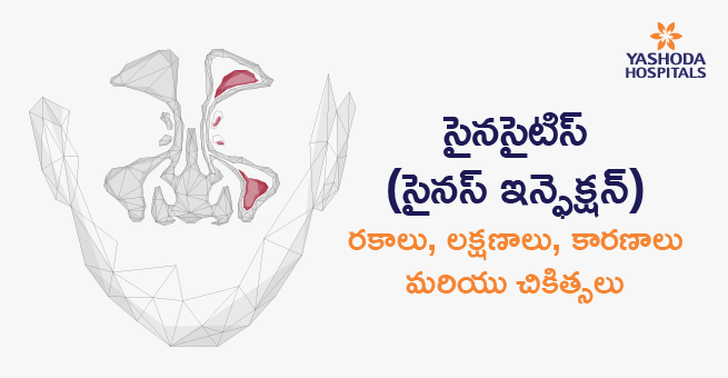 సైనసైటిస్ (సైనస్ ఇన్ఫెక్షన్): రకాలు, లక్షణాలు, కారణాలు మరియు చికిత్సలు