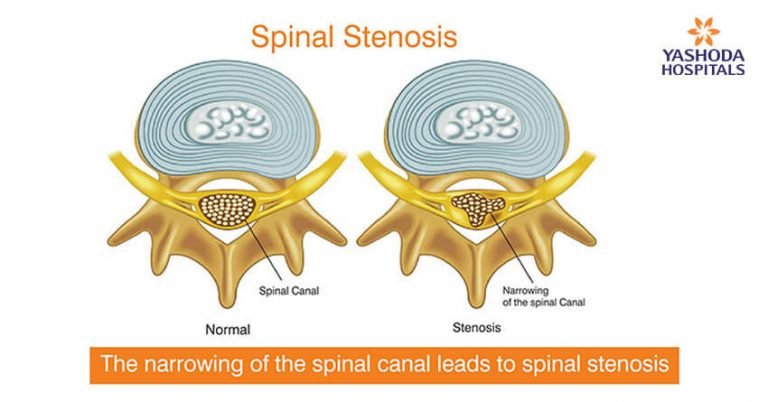 Spinal stenosis - Narrowing on Narrow Spaces of Your Spine