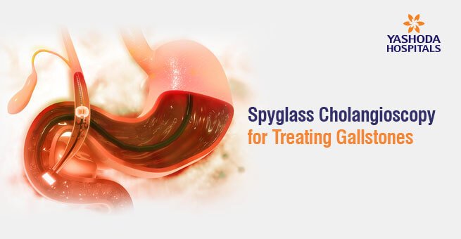 Spyglass Cholangioscopy