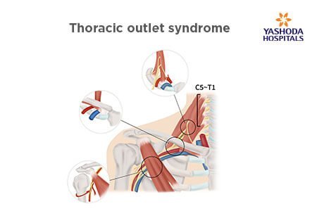gold standard test for thoracic outlet syndrome