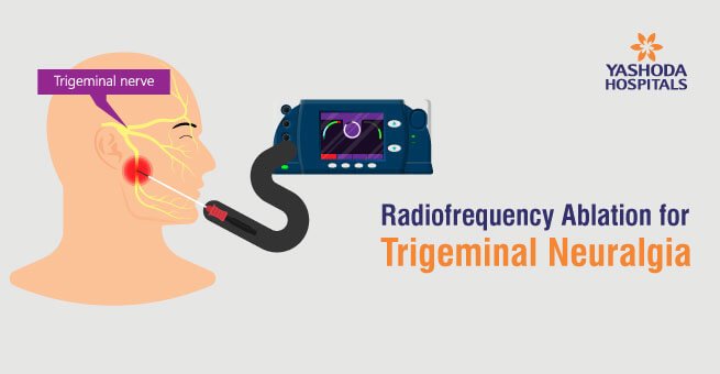 Radiofrequency Ablation for Trigeminal Neuralgia - Yashoda Hospital