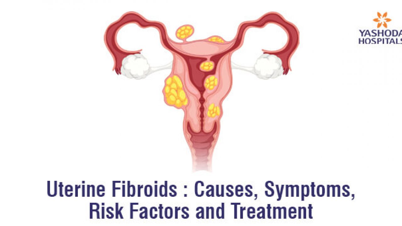 Uterine Fibroids: Causes, Symptoms & Treatment