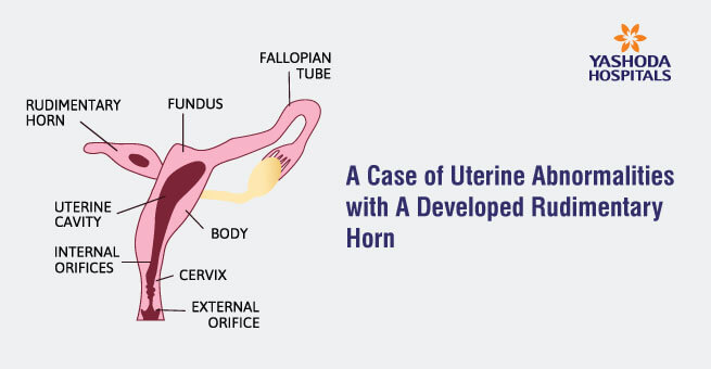 A Case Of Uterine Abnormalities With A Developed Rudimentary Horn