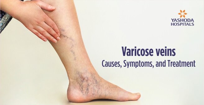 Compression Stockings on Varicose Veins - Ship Hospital