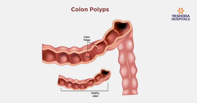 colon-polyps-causes-symptoms-diagnosis-and-treatment