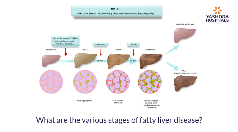 Liver Disease Symptoms Causes Diagnosis And Treatment