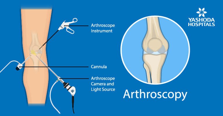 Arthroscopic Reconstructive Surgeries for Sports Injuries