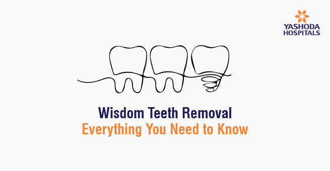 Wisdom Teeth Removal: Everything You Need to Know