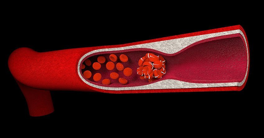 A rare disorder of the blood-coagulation system, causing extensive microscopic clots