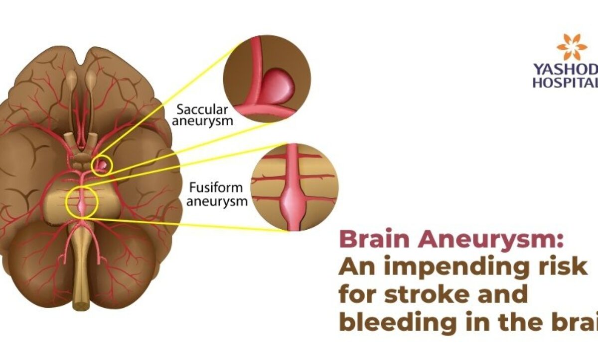 Brain Aneurysm An impending risk for stroke and bleeding in brain